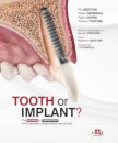 Tooth or Implant