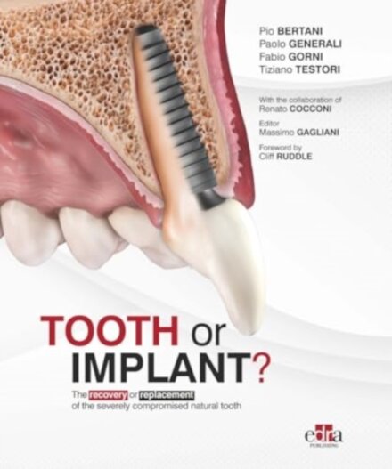 Tooth or Implant