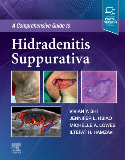 A Comprehensive Guide to Hidradenitis Suppurativa