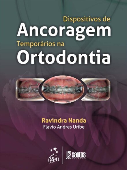 Dispositivos De Ancoragem Temporários Na Ortodontia