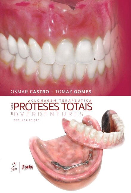Clonagem Terapêutica Para Próteses Tot Overdentures